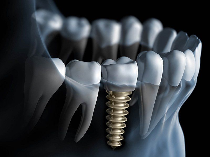 Especialistas en implantes dentales Madrid