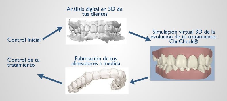 Ortodoncia invisible invisalign al mejor precio en Madrid