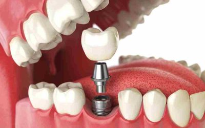 Como cuidar tus implantes dentales