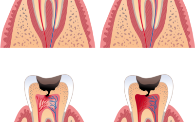 La caries