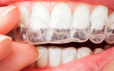 Preguntas frecuentes sobre Invisalign