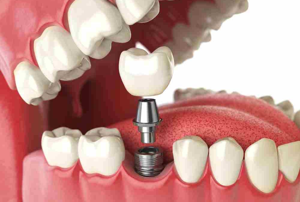 Como cuidar tus implantes dentales