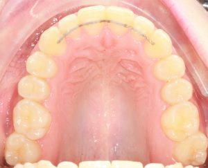 punto final Desgracia emitir Qué retenedor es mejor después de llevar ortodoncia? - Clínica Llidó