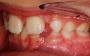 ortodoncia y brackets